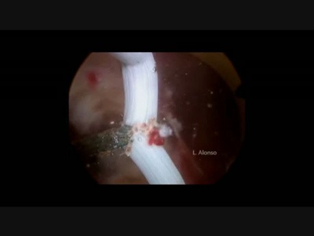 Septate Uterus with Double Cervix and Vaginal Septum