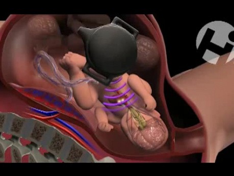 Fetal Monitoring