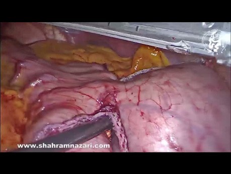 Surgical Treatment of Gastrointestinal Stromal Tumors of the Stomach