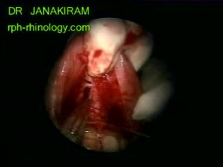 Right Maxillary Sinus Lesion
