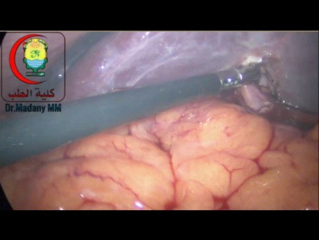 Try To Continue Laparoscopically, To Convert, Or To Postpone Laparoscopic Cholecystectomy