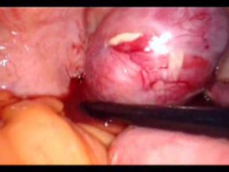 Colonic Perforation With Peritonitis - Laparoscopy (27 of 46)