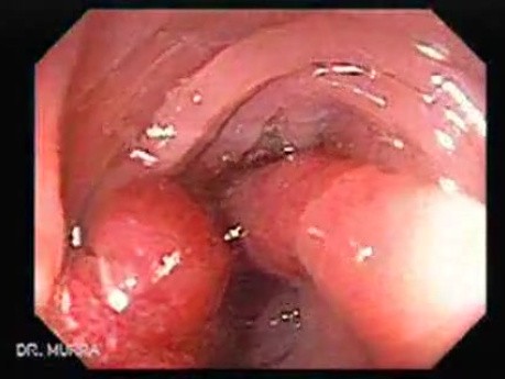 Endoscopic Appearance of Pedicled Polyp of the Descending Colon (2 of 7)