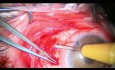 Combined Ahmed Valve Implantation and Closing of Macular Hole
