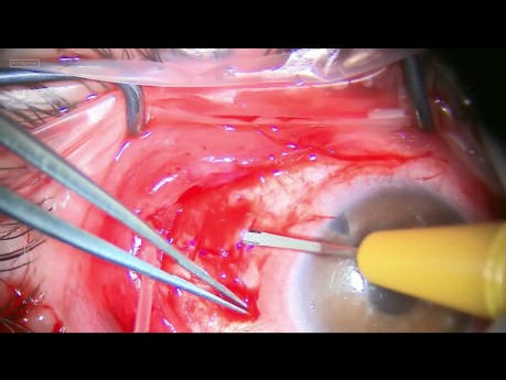 Combined Ahmed Valve Implantation and Closing of Macular Hole