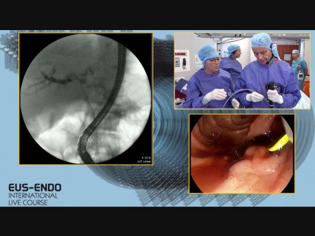 ERCP and Biliary Stenting