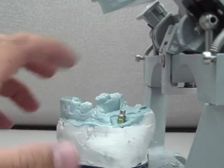 Provisional LAVA CAD Implant Dental Crown