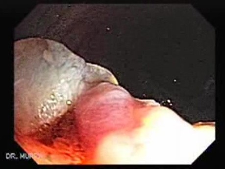 Huge Mass Of The Descending Colon (19 of 25)