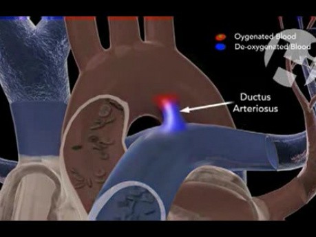 Ductus Arteriosus