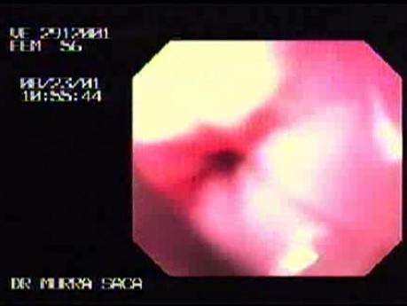 Reflux Esophagitis & Esophageal Stricture - Introducing The Baloon For Dilation