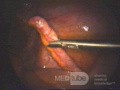 Phlegmonous Appendicitis - Intra-Operative Photo