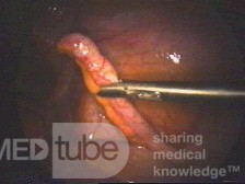 Phlegmonous Appendicitis - Intra-Operative Photo
