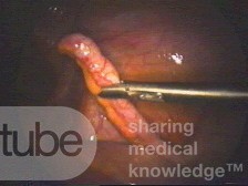 Phlegmonous Appendicitis - Intra-Operative Photo