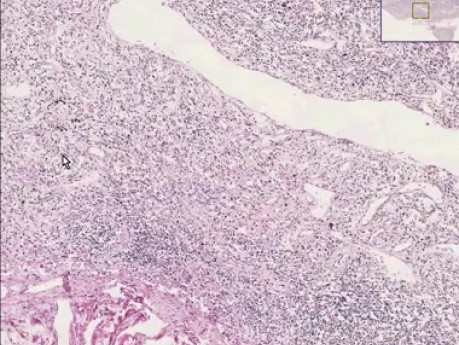 Lymphocyte depleted lymph node
