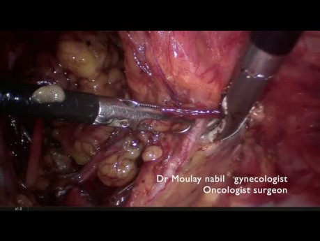 Radical C1 Hysterectomy for a Rare Case of Nos Endocervical Adenocarcinoma