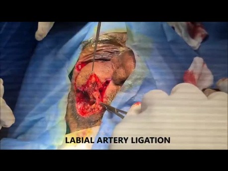 Nasolabial Flap for Face Reconstructionby