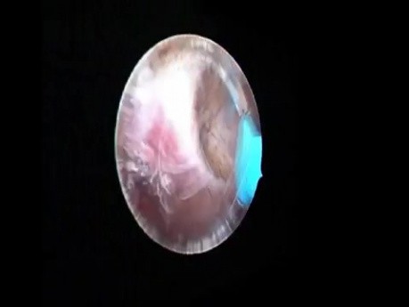 Endometrial ablation with hystero-resector