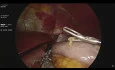 Underbelly Line Sleeve Gastrectomy