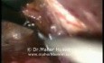 Cardiomyotomy - Laparoscopic Approach