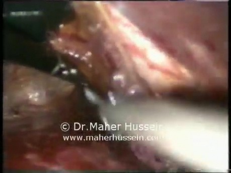 Cardiomyotomy - Laparoscopic Approach