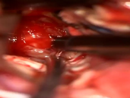 Left Occipital Craniotomy and Resection of Thalamic Lesion 