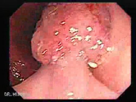 Tubulo-Villous Adenoma (4 of 6)