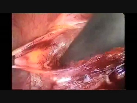 Laparoscopic Pelvic Lymphadenectomy