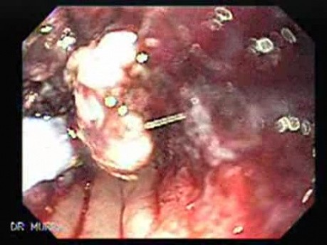 Ablation Of The Distal Esophageal Carcinoma - Part 2