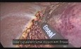 Laparoscopic Left Liver Resection