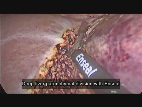 Laparoscopic Left Liver Resection