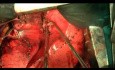 Open Left Upper Lobectomy in Complicated Patient