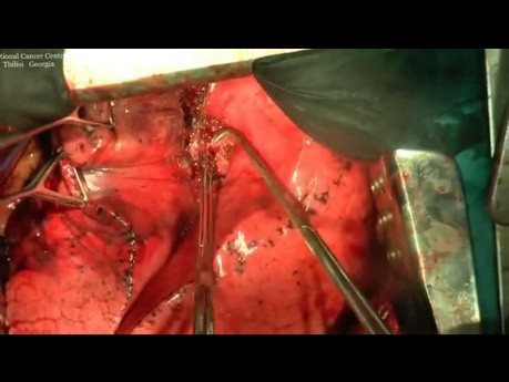 Open Left Upper Lobectomy in Complicated Patient