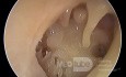 Total Eardrum Perforation