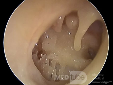 Total Eardrum Perforation