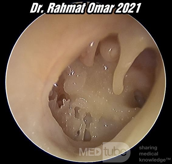 Total Eardrum Perforation