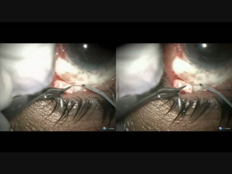Microtrack Failed After Cataract Surgery, Tenon Cyst Formed. Cyst Cut and MTF Restarted