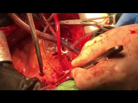 RV Training Protocol During Weaning of From CPB in Patient Who Undergone Heart Transplantation
