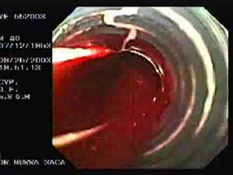 Acute Variceal Bleeding - Blood Emerging into the Banding Apparatus, Part 2