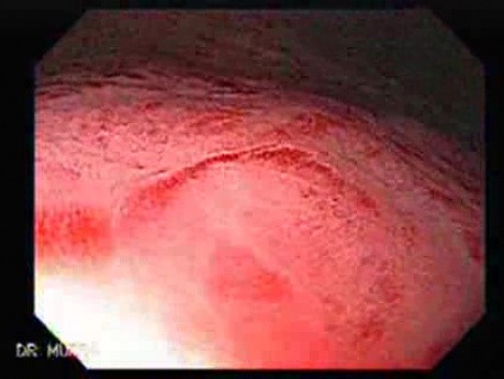 Acute Gastritis (Pangastritis) (4 of 10)
