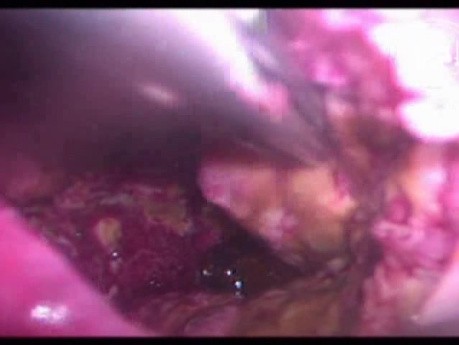 Laparoscopic Tube Cholecystostomy Is Still Useful In The Management Of Complicated Acute Cholecystitis