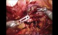 Robotic Preperitoneal Repair of Large Spigelian Hernia in the Setting of Large Abdominal Aortic Aneurysm