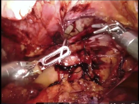 Robotic Preperitoneal Repair of Large Spigelian Hernia in the Setting of Large Abdominal Aortic Aneurysm
