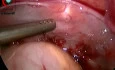 Can We Give Laparoscopy a Role in Trauma?