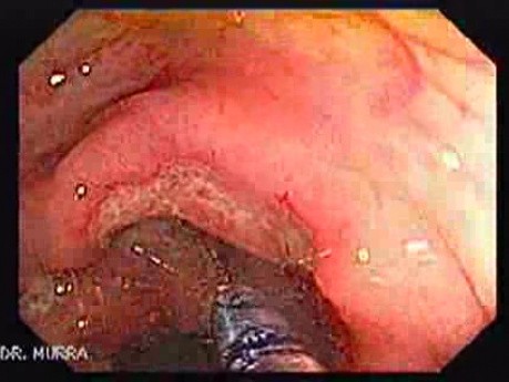 Colonic Tuberculosis Mimicking Crohn's Disease (5 of 12)