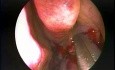 Hypoplastic Maxillary Sinus Type 2 - Endoscopic Management