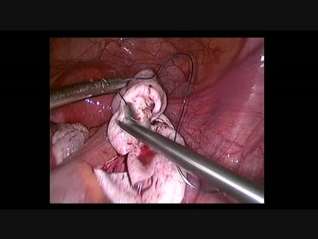 Mucinous Cyst