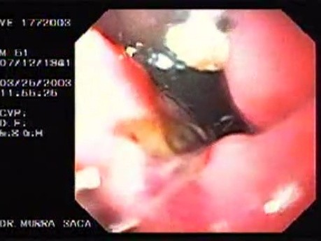 Banding of esophageal varices (13 of 17)