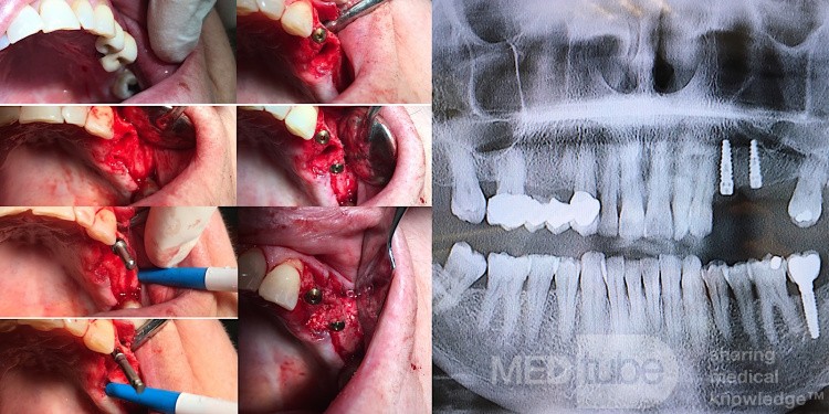 Implant Maxilar Surgery in Sector 2