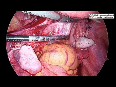 Total Laparoscopic Hysterectomy by Three 5 mm Ports
