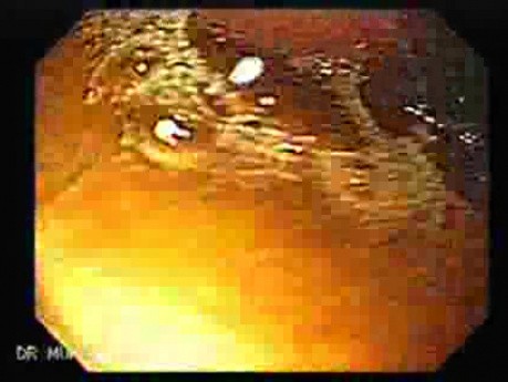 Gastrointestinal Stromal Tumor - GIST (3 of 13)